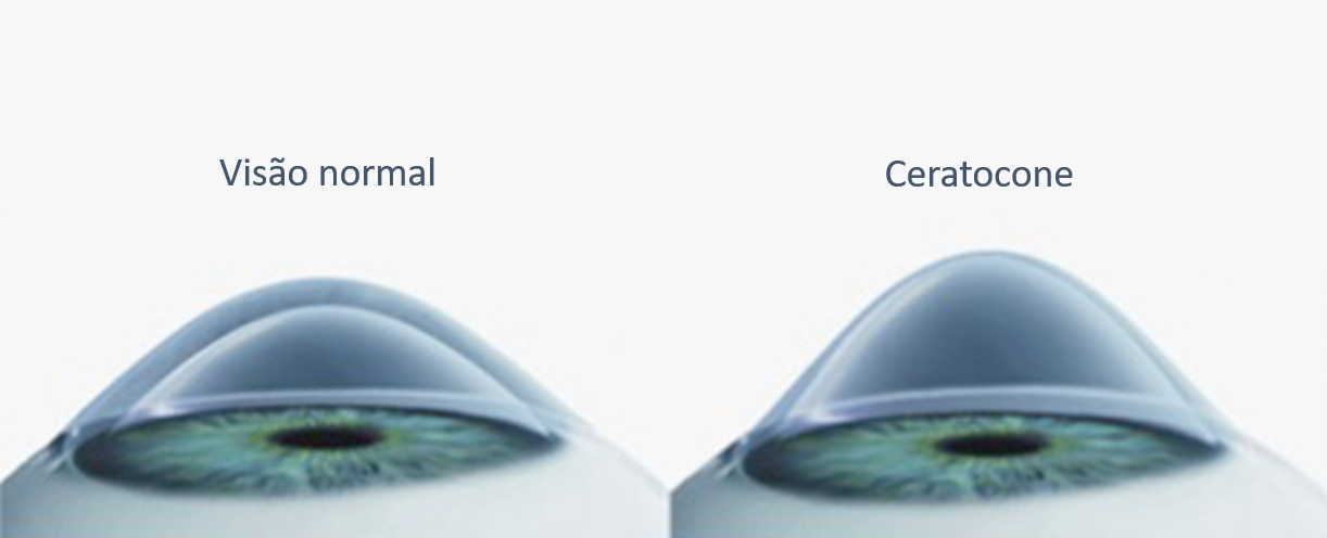 ceratocone