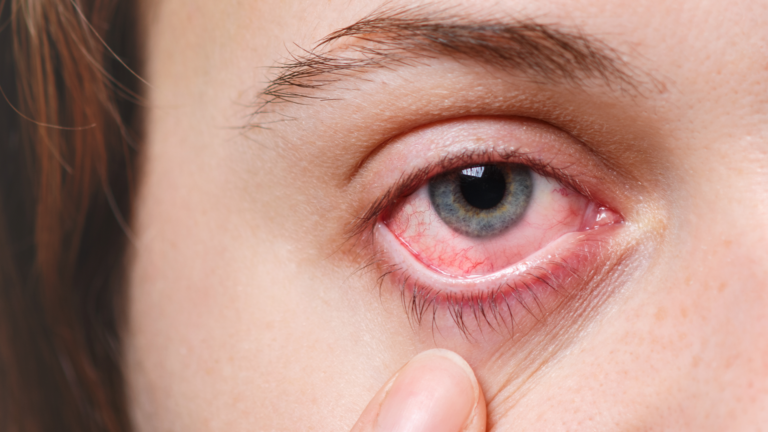 Toda conjuntivite é contagiosa? Entenda as diferenças entre os tipos